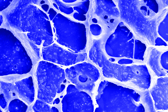 Sprayable gel developed by UCLA-led team could help the body fight off cancer after surgery
