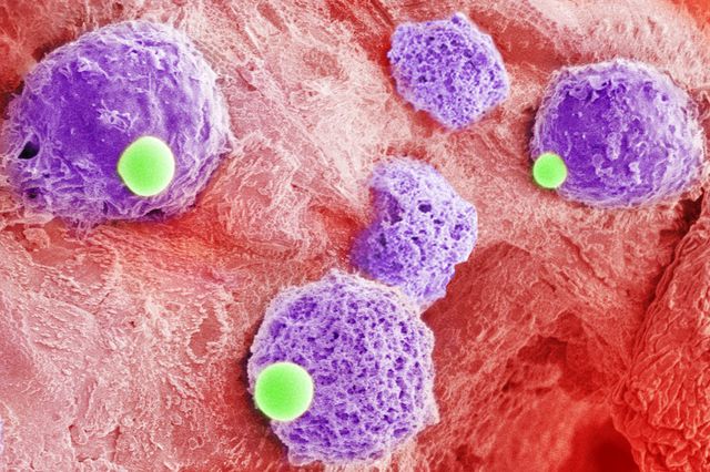 Two-cells-in-one combo could be platform to bolster leukemia treatment