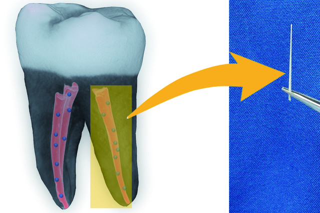Nanodiamonds might prevent tooth loss after root canals